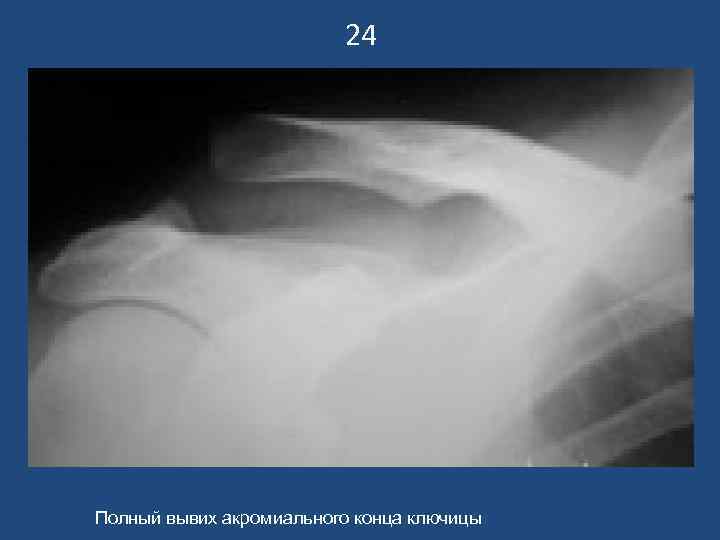      24 Полный вывих акромиального конца ключицы 