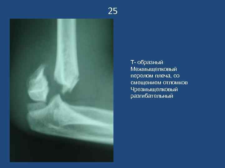 25   Т- образный Межмыщелковый перелом плеча, со смещением отломков Чрезмыщелковый разгибательный 