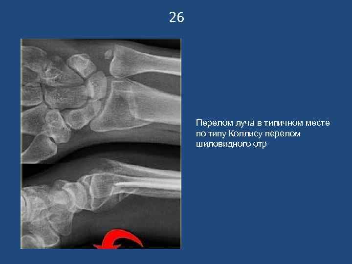 26   Перелом луча в типичном месте по типу Коллису перелом шиловидного отр