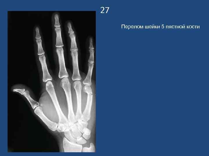 27 Перелом шейки 5 пястной кости 