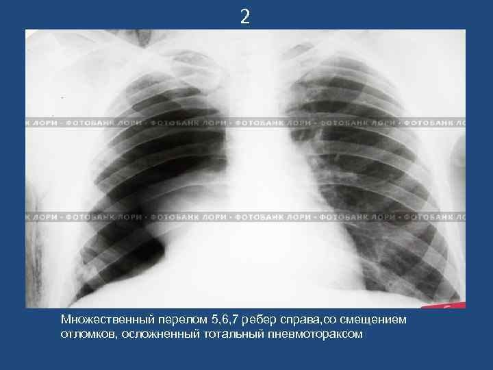       2 Множественный перелом 5, 6, 7 ребер справа,