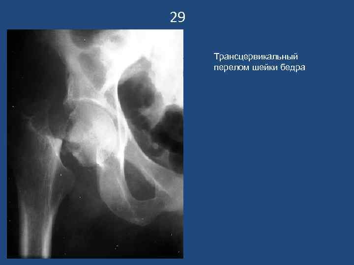29  Трансцервикальный перелом шейки бедра 
