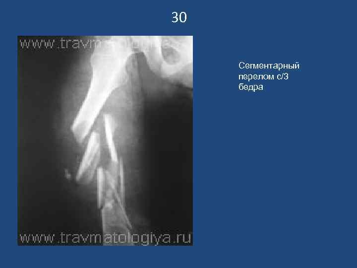 30  Сегментарный перелом с/3 бедра 
