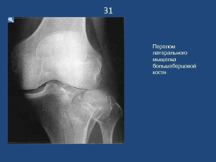 31  Перелом латерального мыщелка большеберцовой кости 