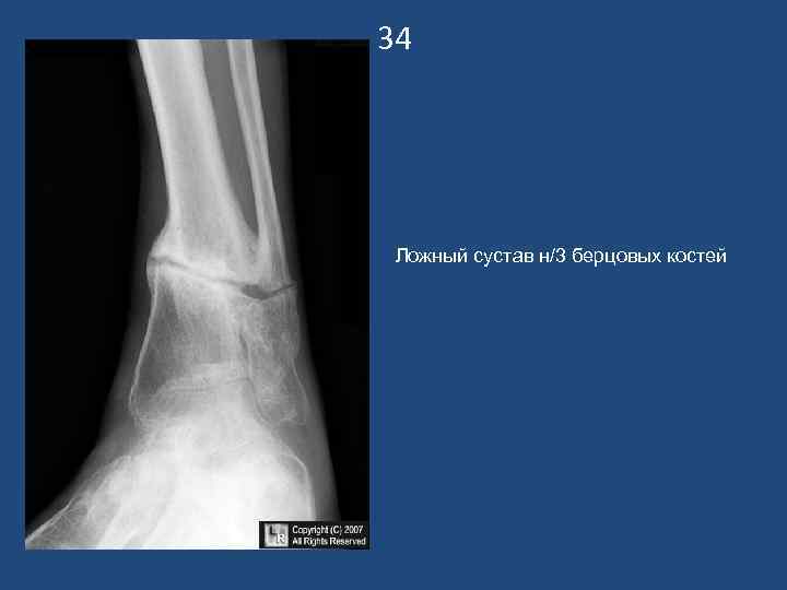 34 Ложный сустав н/3 берцовых костей 