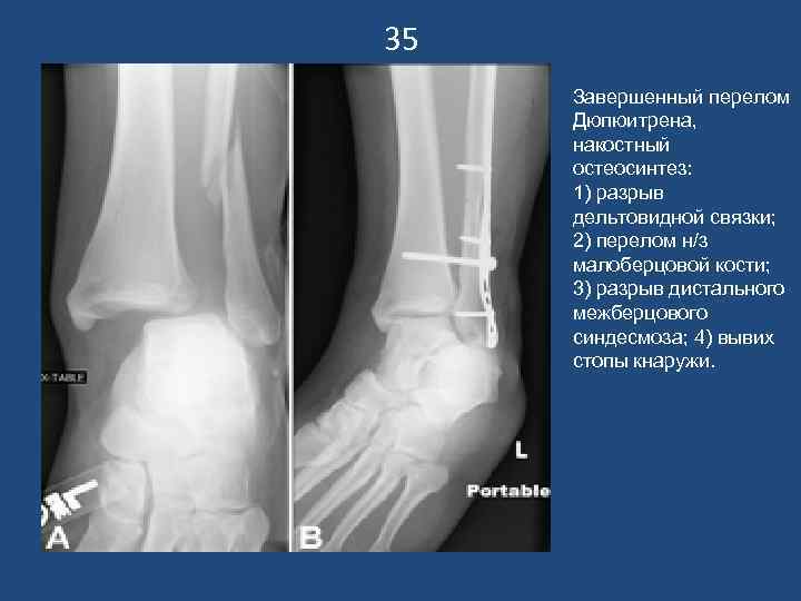 35 Завершенный перелом Дюпюитрена,  накостный остеосинтез:  1) разрыв дельтовидной связки;  2)