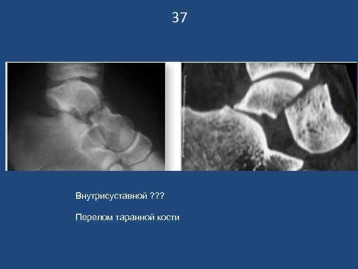      37 Внутрисуставной ? ? ?  Перелом таранной кости