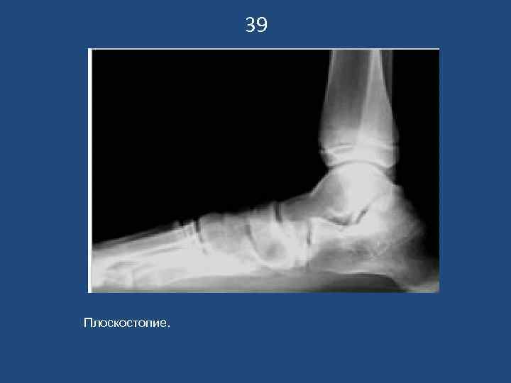     39 Плоскостопие. 