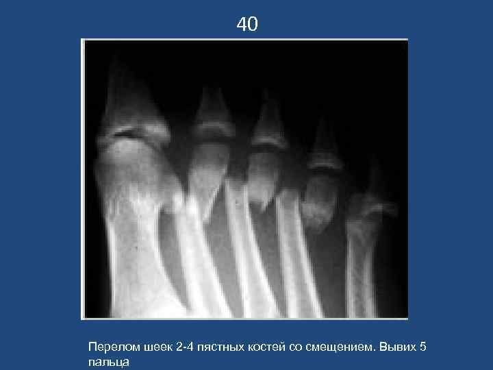     40 Перелом шеек 2 -4 пястных костей со смещением. Вывих