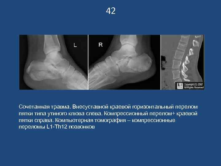      42 Сочетанная травма. Внесуставной краевой горизонтальный перелом пятки типа