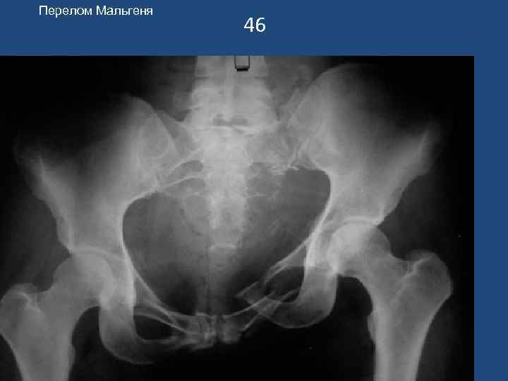 Перелом Мальгеня    46 