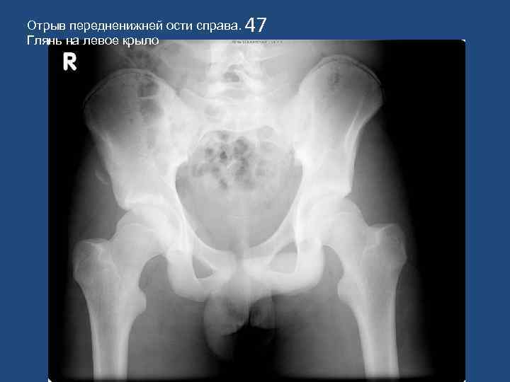 Отрыв передненижней ости справа.  47 Глянь на левое крыло 