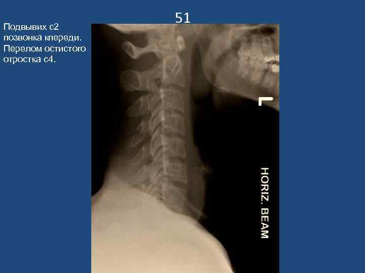 Подвывих с2     51 позвонка кпереди. Перелом остистого отростка с4. 