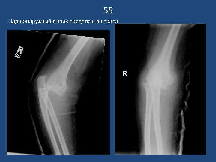       55 Задне-наружный вывих предплечья справа 