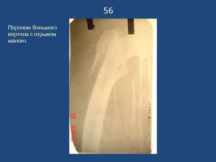     56 Перелом большого вертела с отрывом малого 