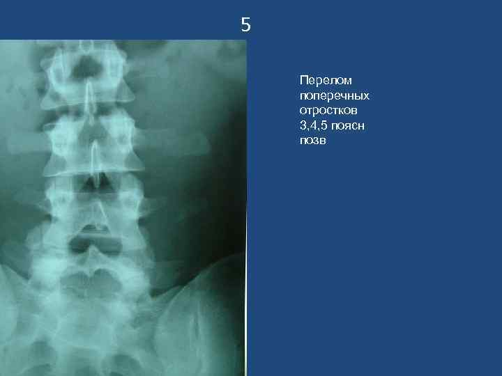 5 Перелом поперечных отростков 3, 4, 5 поясн позв 