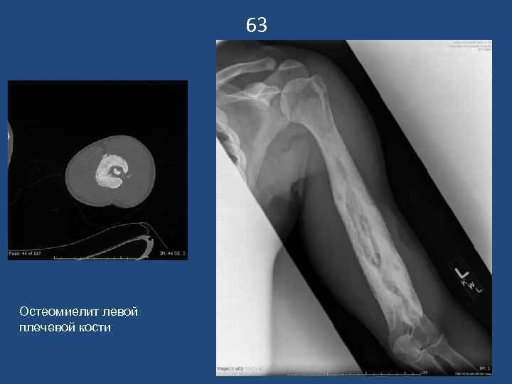     63 Остеомиелит левой плечевой кости 