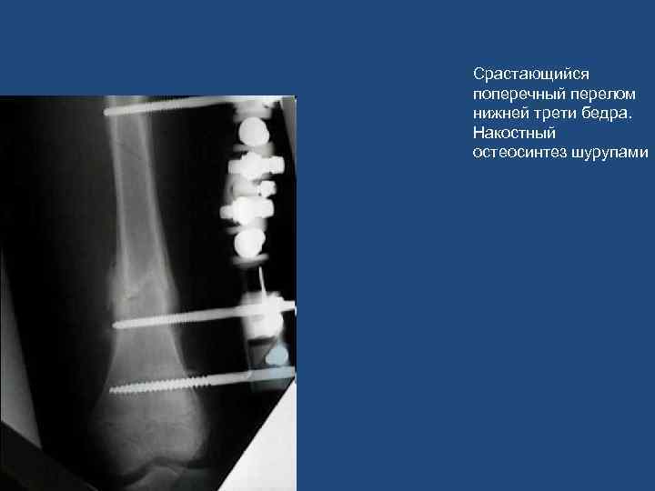 Срастающийся поперечный перелом нижней трети бедра. Накостный остеосинтез шурупами 