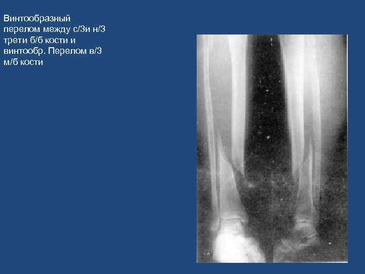 Винтообразный перелом между с/3 и н/3 трети б/б кости и винтообр. Перелом в/3 м/б