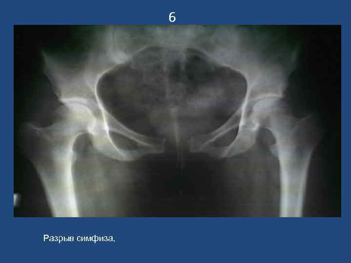    6 Разрыв симфиза, 