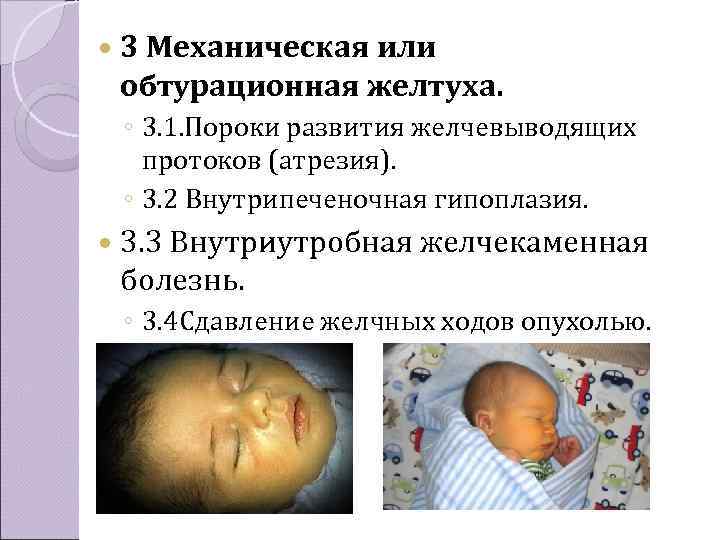  3 Механическая или  обтурационная желтуха.  ◦ 3. 1. Пороки развития желчевыводящих