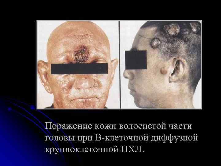 Поражение кожи волосистой части головы при В-клеточной диффузной крупноклеточной НХЛ. 