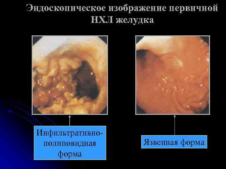 Эндоскопическое изображение первичной   НХЛ желудка Инфильтративно-  полиповидная  Язвенная форма 