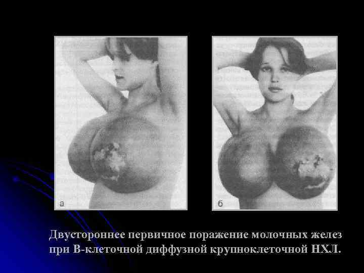 Двустороннее первичное поражение молочных желез при В-клеточной диффузной крупноклеточной НХЛ. 