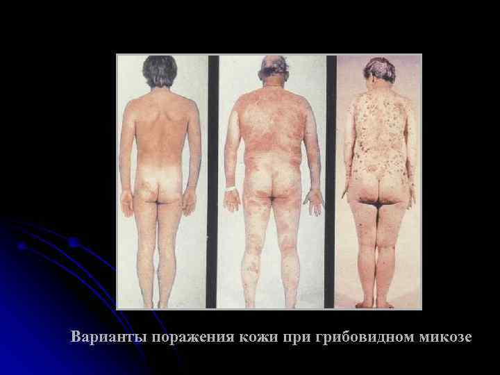 Варианты поражения кожи при грибовидном микозе 
