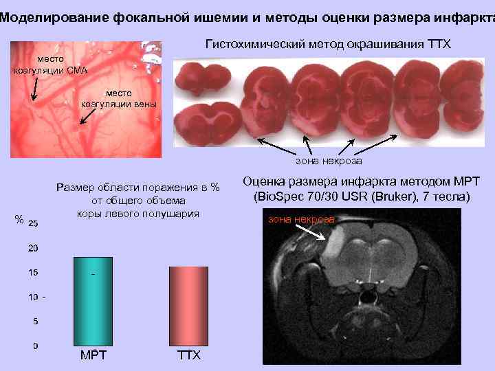 Моделирование фокальной ишемии и методы оценки размера инфаркта Гистохимический метод окрашивания ТТХ место коагуляции