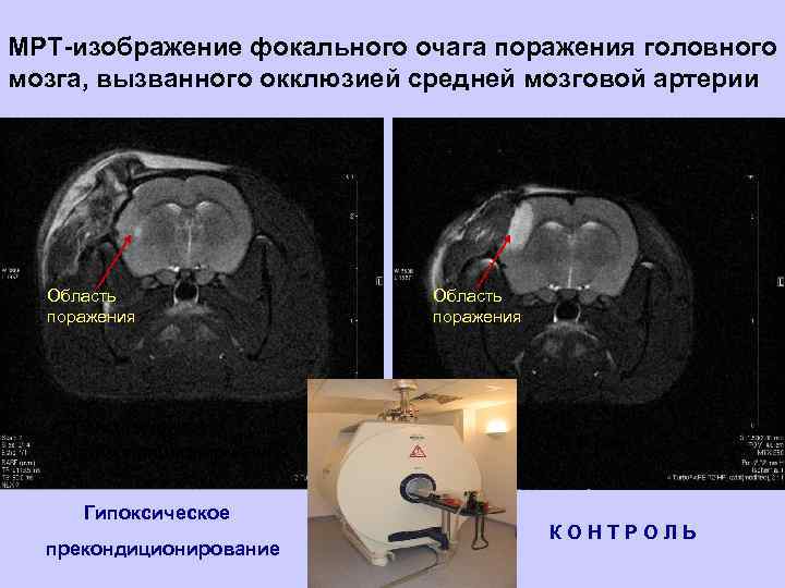 МРТ-изображение фокального очага поражения головного мозга, вызванного окклюзией средней мозговой артерии Область поражения Гипоксическое