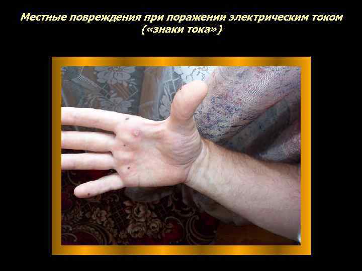 Местные повреждения при поражении электрическим током ( «знаки тока» ) 