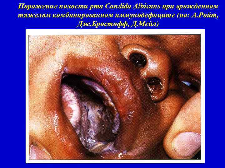 Поражение полости рта Candida Albicans при врожденном тяжелом комбинированном иммунодефиците (по: А. Ройт, Дж.