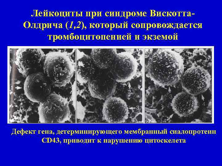 Лейкоциты при синдроме Вискотта. Олдрича (1, 2), который сопровождается тромбоцитопенией и экземой Дефект гена,