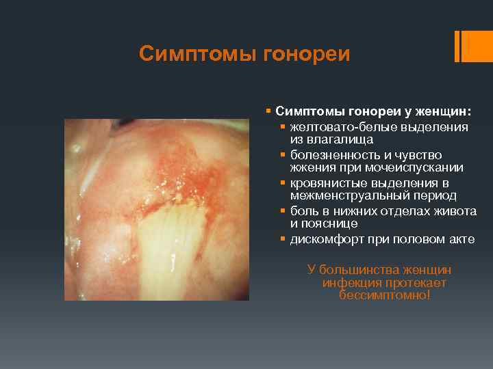 Симптомы гонореи  § Симптомы гонореи у женщин:   § желтовато-белые выделения 