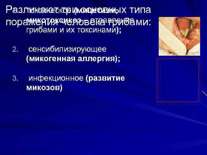 Различают тримицетизм, типа 1. токсическое ( основных микотоксикоз – отравления поражения человека грибами: 