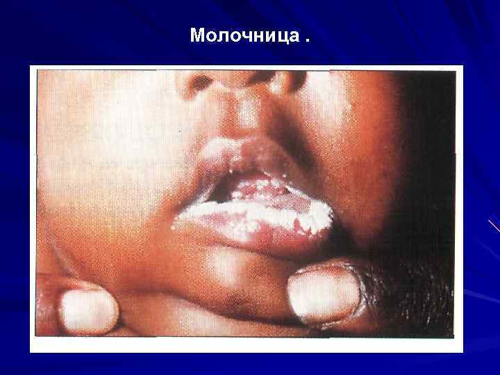 Молочница. 
