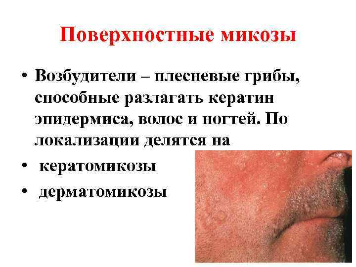   Поверхностные микозы • Возбудители – плесневые грибы,  способные разлагать кератин 