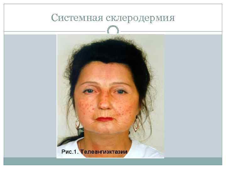 Системная склеродермия 