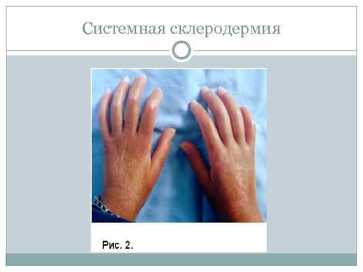 Системная склеродермия 