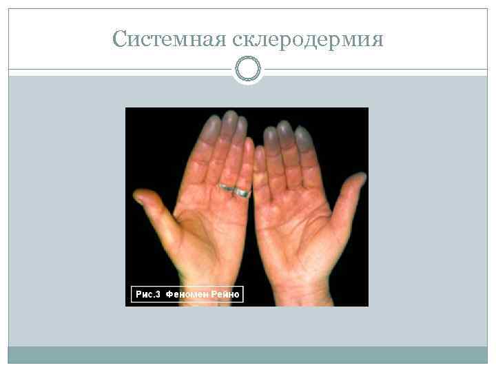 Системная склеродермия 