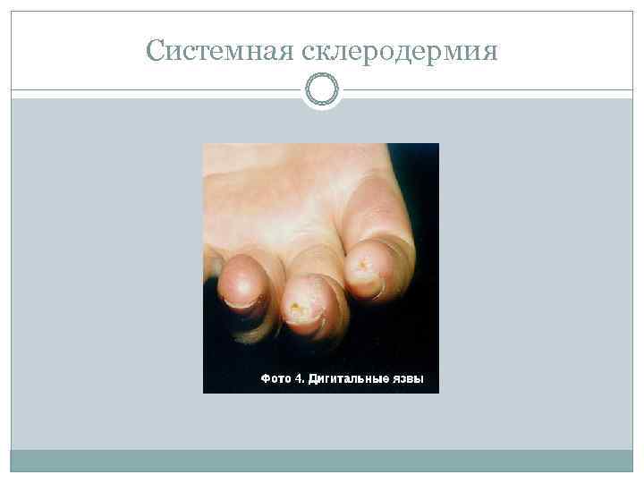 Системная склеродермия 