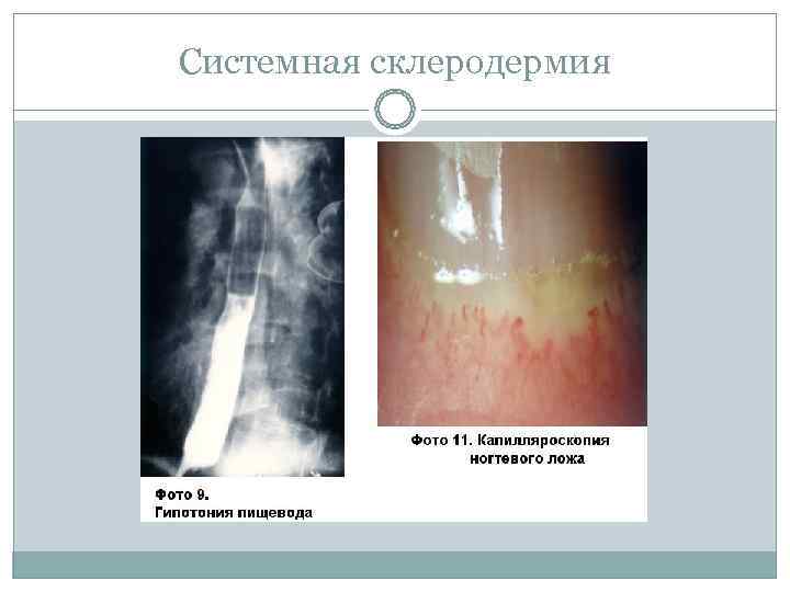Системная склеродермия 