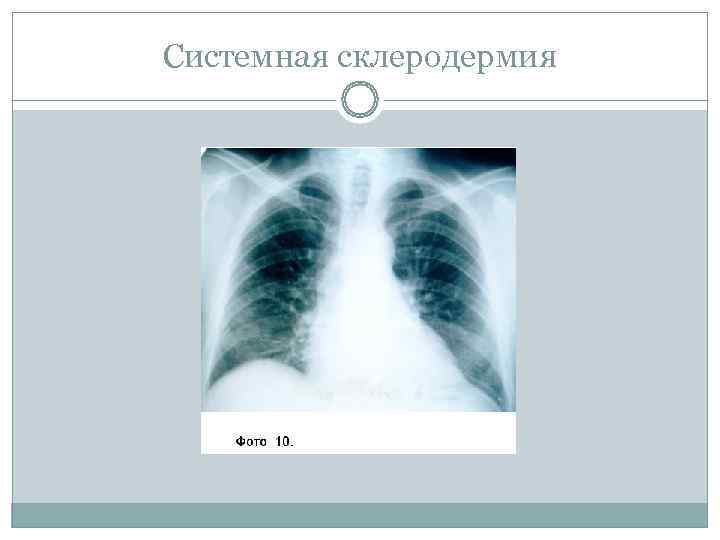 Системная склеродермия 