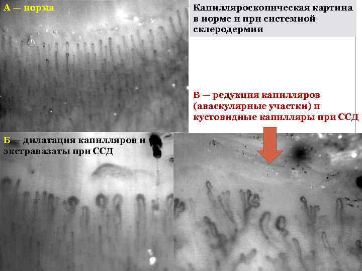 А — норма     Капилляроскопическая картина     
