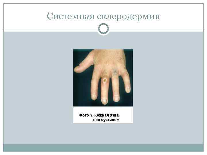 Системная склеродермия 