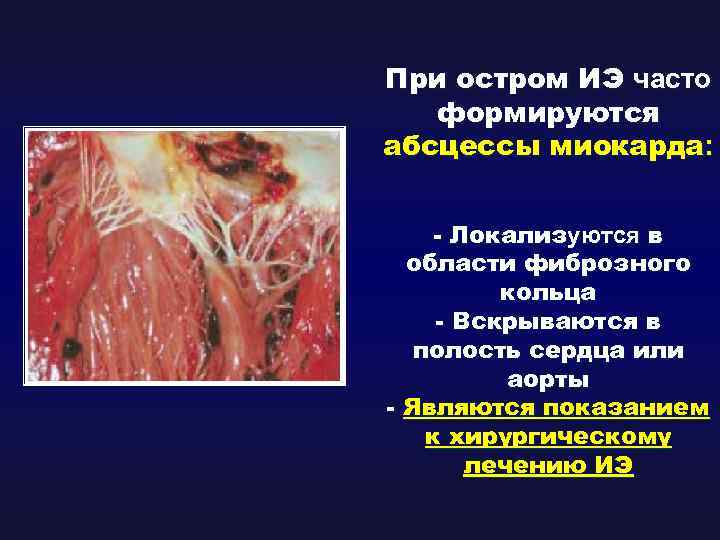 При остром ИЭ часто формируются абсцессы миокарда: - Локализуются в области фиброзного кольца -