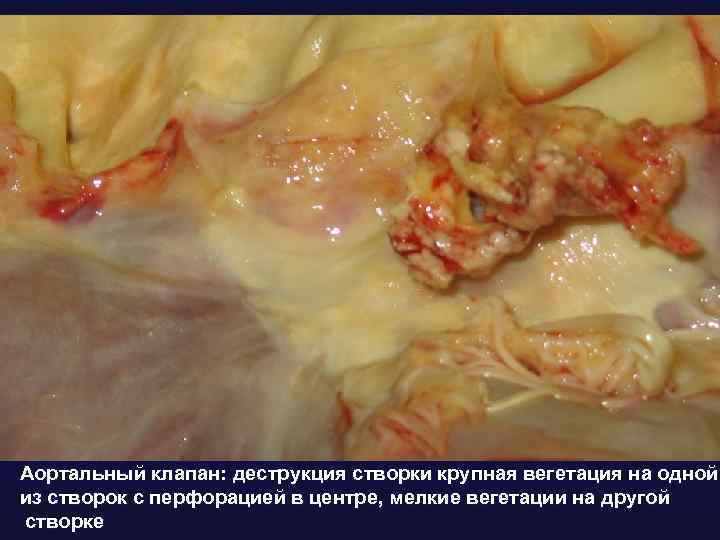 Аортальный клапан: деструкция створки крупная вегетация на одной из створок с перфорацией в центре,