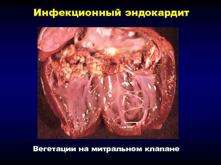 Инфекционный эндокардит Вегетации на митральном клапане 