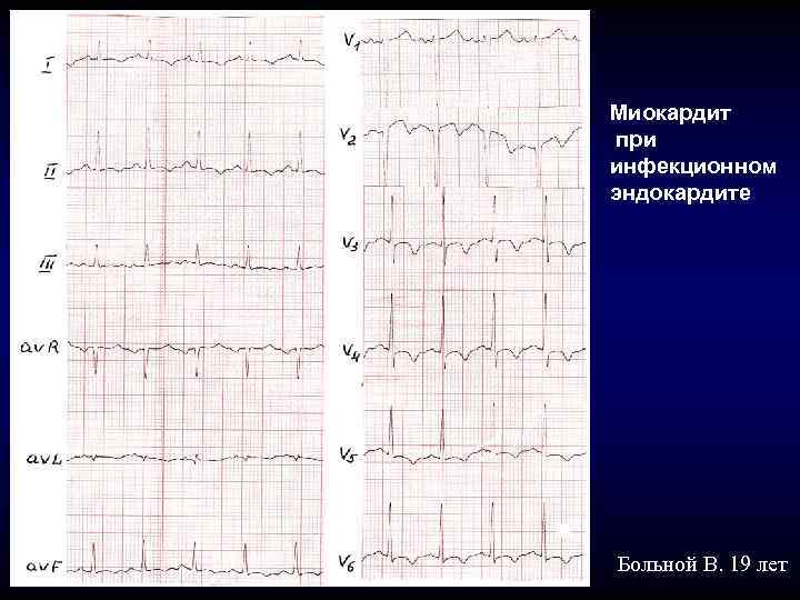 Миокардит при инфекционном эндокардите Больной В. 19 лет 